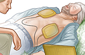 Automated External Defibrillator Medical Illustration