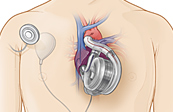 Artificial Heart Medical Illustration