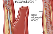 Carotid Artery Angioplasty - Stent Placement Medical Illustration
