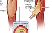 Carotid Endarterectomy Medical Illustration