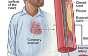 Coronary Angioplasty - Stent Placement Medical Illustration
