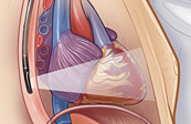 Transesophageal Endoscopic Ultrasound Medical Illustration