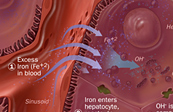 Hemochromatosis MOD Medical Illustration