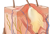 Skin Cross-Section – Pimple Medical Illustration