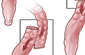 Colectomy Medical Illustration