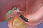 Endoscopic Cholecystectomy Medical Illustration