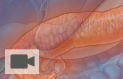 Pancreatic auto islet cell transplantation medical animation