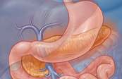 Pancreatic Auto Islet Cell Transplantation Medical Illustration