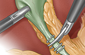 Laparascopic Cholecystectomy Medical Illustration