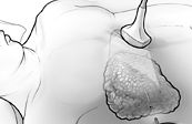 Liver Biopsy Medical Illustration