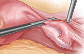 Laparoscopic Hysterectomy Medical Illustration