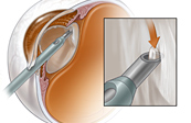 Cataract Surgery Medical Illustration