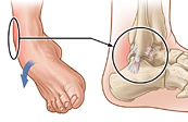 Angle Ligament Injuries Medical Illustration