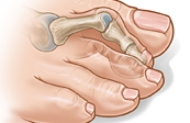 Hammer Toe Medical Illustration