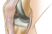 Total Knee Replacement Medical Illustration
