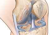 Arthritic Knee Medical Illustration