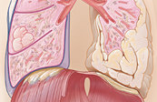 Asbestos-Related Lung Diseases Medical Illustration