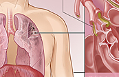 COPD Medical Illustration