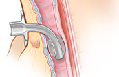 Tracheostomy Tube Medical Illustration