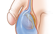 Cystocele Medical Illustration