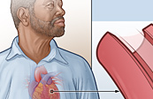 Smoking and Heart Disease Medical Illustration