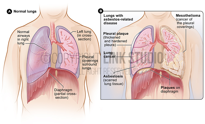 Asbestosis medical illustration