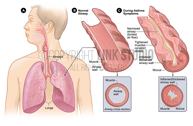Airways with asthma medical illustration