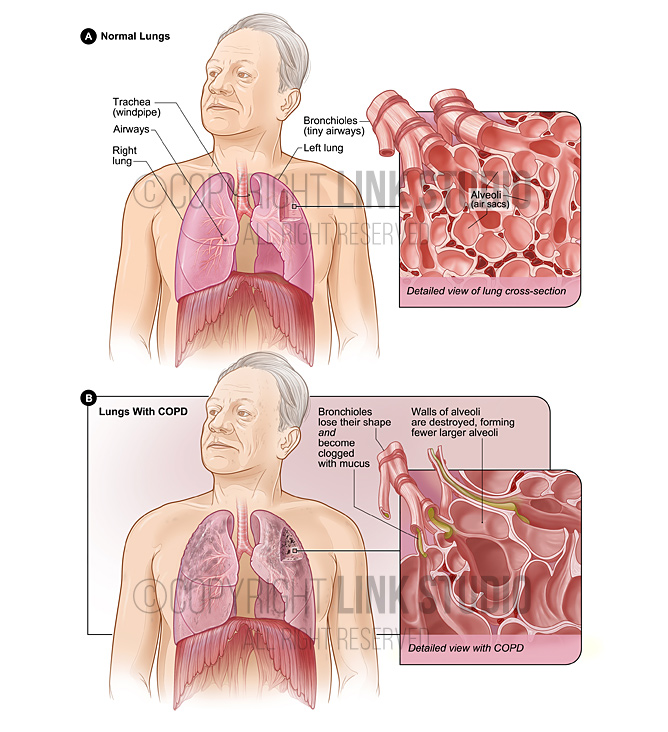 Chronic obstructive pulmonary fibrosis (COPD) medical illustration