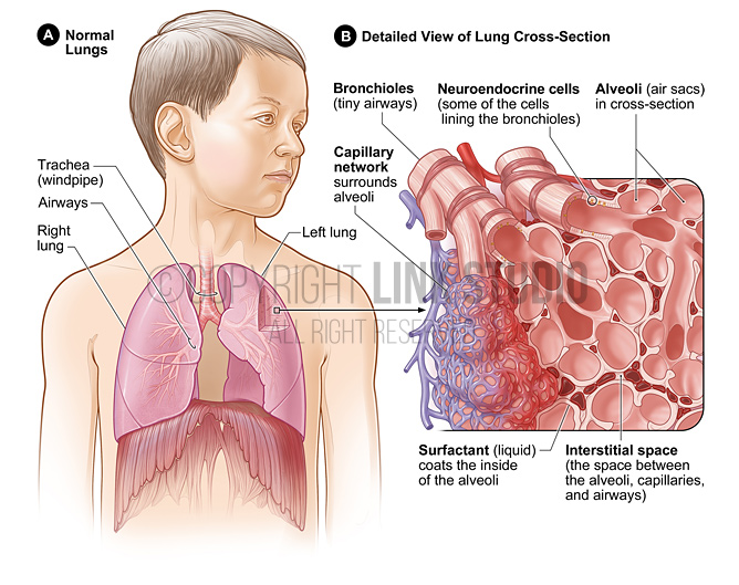 Childhood interstitial lung disease Primary ciliary dyskinesia medical illustration