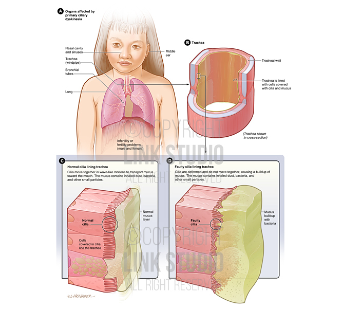 Primary ciliary dyskinesia medical illustration