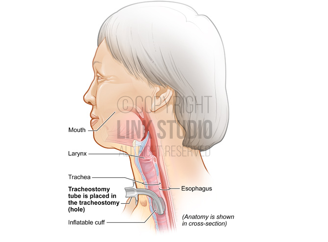 Tracheostomy tube medical illustration