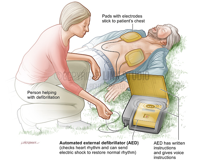 Automated External Defibrillator (AED) medical illustration