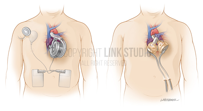 Total artificial heart comarison medical illustration