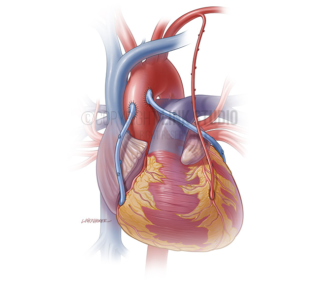 Coronary artery bypass grafts medical illustration