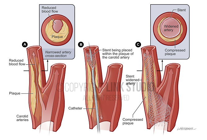 Carotid stent placement medical illustration