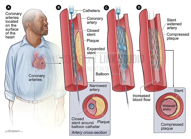Coronary stent placement medical illustration