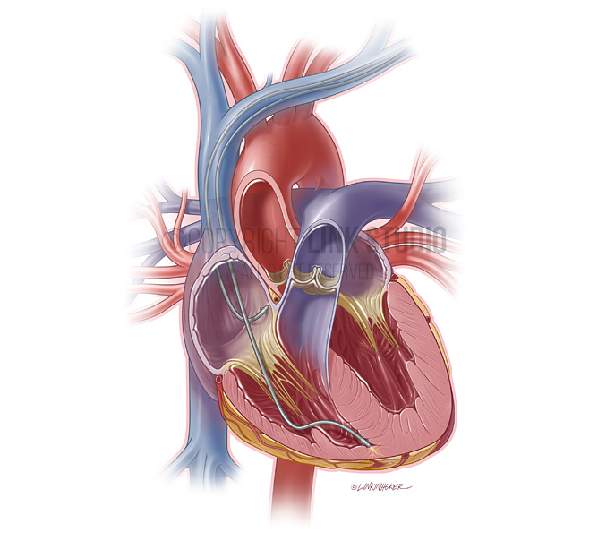 Interior of heart with pacemaker leads medical illustration