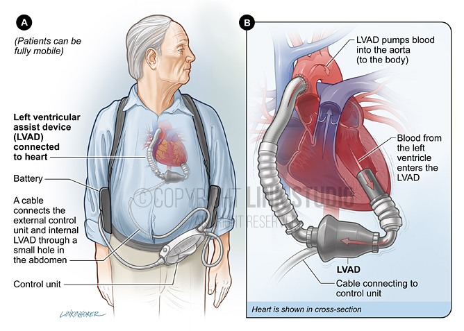 Left ventricular assist device medical illustration