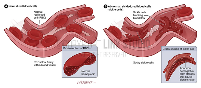 Sickle cell disease medical illustration