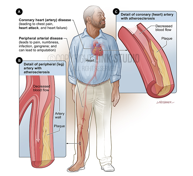 Smoking and heart disease Sickle cell disease medical illustration