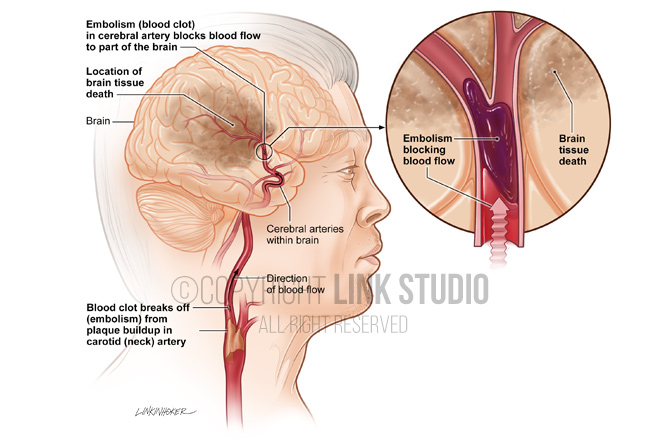 Ischemic stroke medical illustration