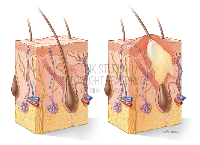 Skin cross-section with pustule medical illustration