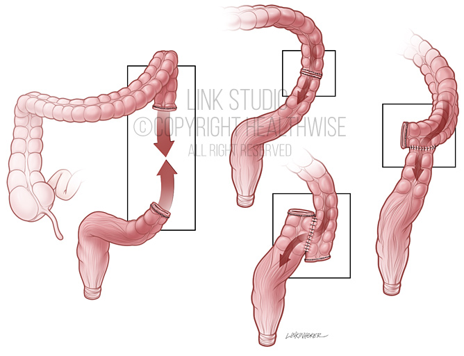Colectomy medical illustration