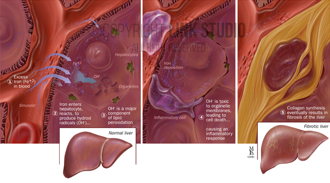 Liver cells - hemochromatosis medical illustration