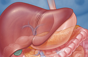 Pancreatic Auto Islet Cell Transplantation Medical Illustration