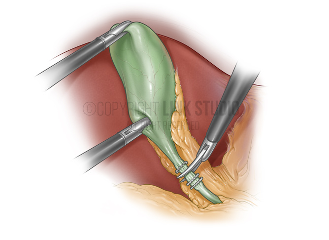 Laparoscopic cholecystectomy medical illustration