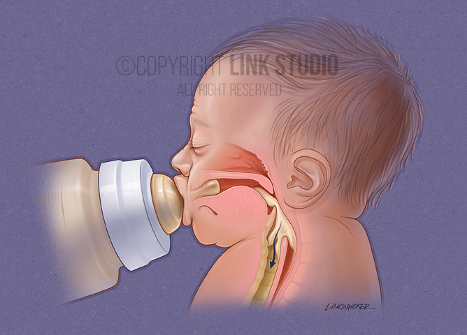 Infant swallow with aspiration medical illustration