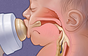 Infant swallow with aspiration medical illustration