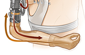 Neural arm prosthesis medical illustration