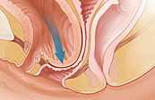 Cystocele medical illustration
